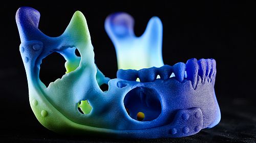 Metal Personalized Implants