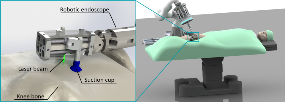 Miniature parallel robot for minimally invasive laser osteotomy with an attachment mechanism