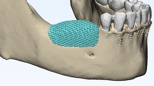Implant design