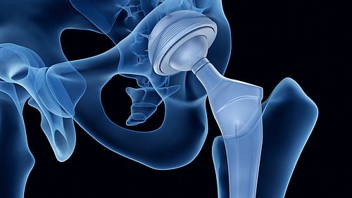 Comprehensive analysis of determinants of polyethylene wear and the related tissue response to improve outcomes in total hip arthroplasty