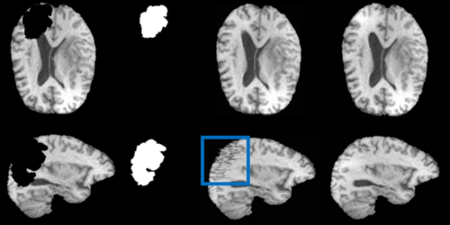Healthy Brain Tissue Inpainting