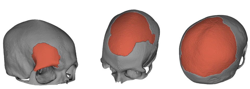 Example implants generated by our method. The pictures show that the model is capable of producing suitable implants for different defect locations and size.