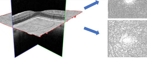 Volumetric OCT Angiography for novel biomarkers