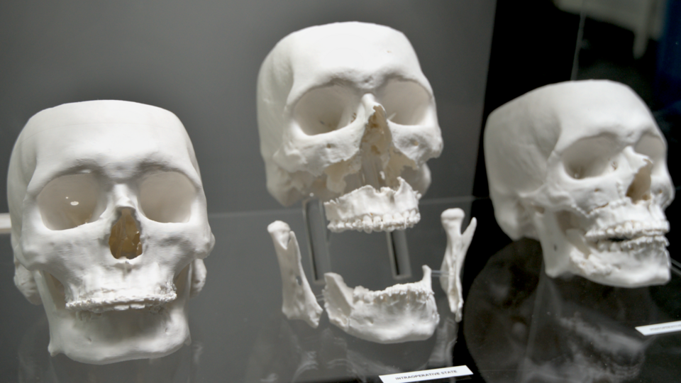 PLA 3D Printed Anatomical Model