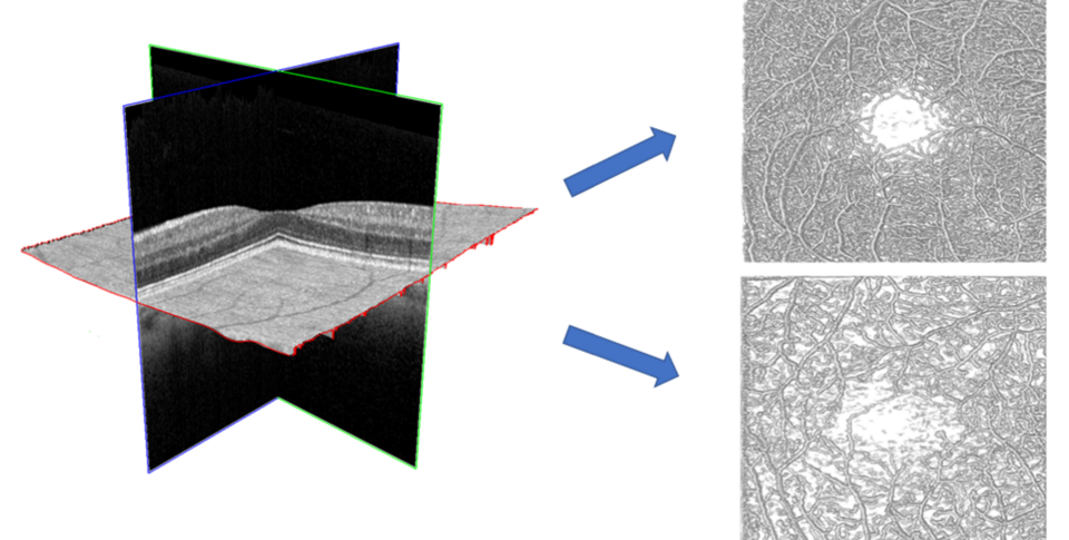 Volumetric OCT Angiography for novel biomarkers