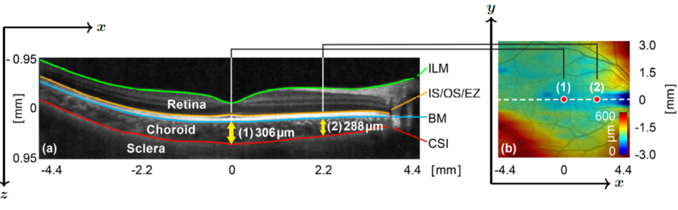 Detecting Early Choroidal Changes Using Piecewise Rigid Image ...