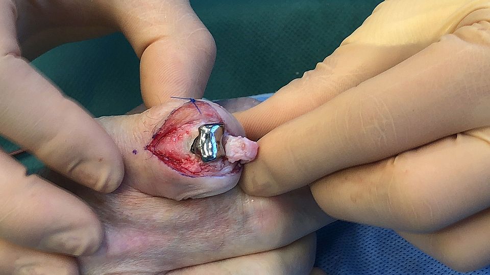 PSI-Joint resurfacing