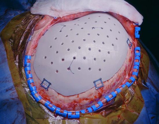 Intraoperative Photo of University Hospital Basel’s first 3D-printed personalized Polyetheretherketone (PEEK) cranial implant