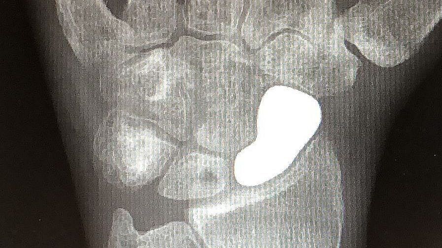 Patient-specific bone replacement