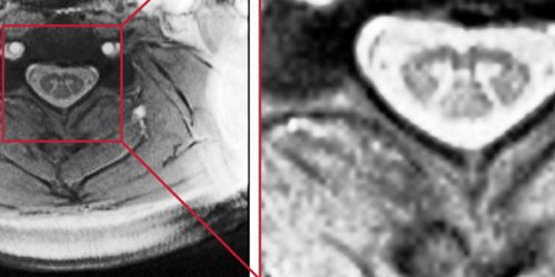 Segmentation of the Gray and White Matter in the Human Spinal Cord