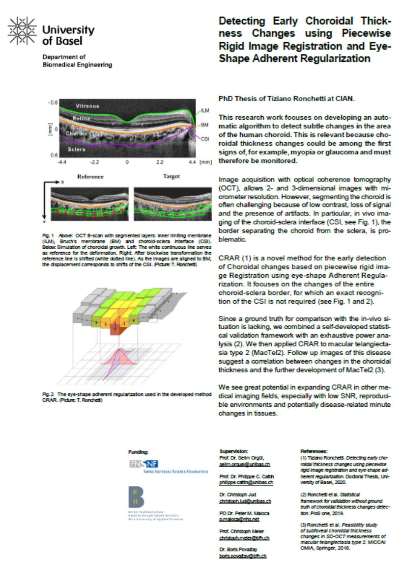 Detecting Early Choroidal Thickness Changes using Piecewise Rigid Image Registration and Eye- Shape Adherent Regularization